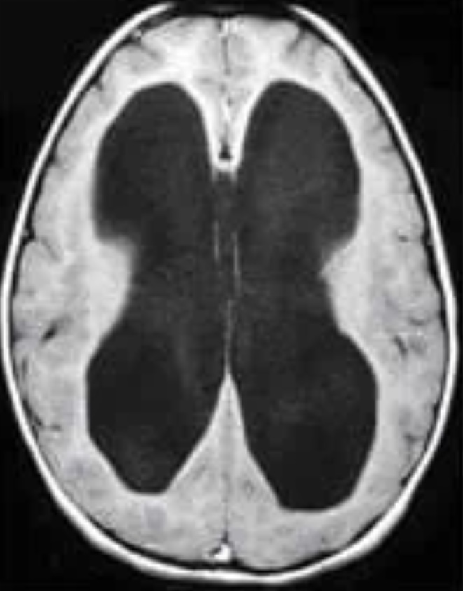 Imagen ilustrativa de hidrocefalia